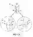 Fig. 42 - Generation of a computerized bone model representative of a pre-degenerated state and useable in the design and manufacture of arthroplasty devices