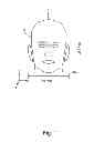 Fig. 02 - BTE hearing aid having two driven antennas