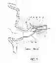 Fig. 02 - CIC Hearing Aid