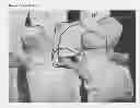 Fig. 02 - Ultrasound Enhanced Selective Tissue Removal Method and Apparatus