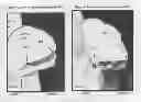 Fig. 08 - Ultrasound Enhanced Selective Tissue Removal Method and Apparatus