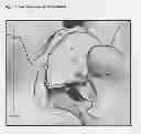 Fig. 09 - Ultrasound Enhanced Selective Tissue Removal Method and Apparatus