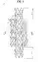 Fig. 02 - STENT