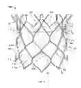 Fig. 02 - Balloon sizing device and method of positioning a prosthetic heart valve