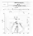 Fig. 11 - Progressive ophthalmic lens
