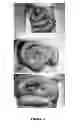 Fig. 03 - Minimizing intestinal dysfunction