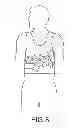 Fig. 12 - Cardiac navigation system including electrode array for use therewith
