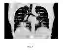 Fig. 06 - Method and apparatus for pulmonary ventilation imaging using local volume changes