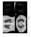Fig. 08 - Method and apparatus for pulmonary ventilation imaging using local volume changes