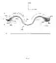 Fig. 04 - Compression bone staple