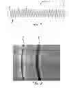 Fig. 02 - MULTISTRAND COIL FOR INTERVENTIONAL THERAPY