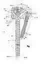 Fig. 02 - Device, kit and method for correction of spinal deformity