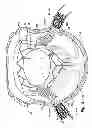 Fig. 04 - Stent and method for maintaining the area of a body lumen