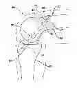 Fig. 01 - Flipping-type graft fixation device and method