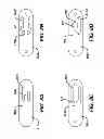 Fig. 09 - Flipping-type graft fixation device and method