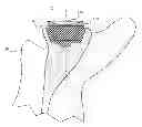 Fig. 01 - Method of implanting a revision glenoid device