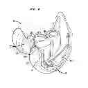 Fig. 07 - Stabilized knee prosthesis