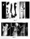 Fig. 16 - Phospholipid analogs as diapeutic agents and methods thereof