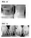 Fig. 12 - PHARMACEUTICAL COMPOSITION FOR TREATMENT AND PREVENTION OF TH3 MARCH-RELATED DISEASES