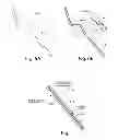 Fig. 08 - MULTI-STAGE PROCEDURES WITH A MODIFIABLE FIBER AND A GUIDE TUBE CONTAINING AN INSTRUMENT