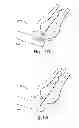 Fig. 13 - MULTI-STAGE PROCEDURES WITH A MODIFIABLE FIBER AND A GUIDE TUBE CONTAINING AN INSTRUMENT