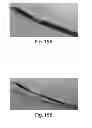 Fig. 16 - MULTI-STAGE PROCEDURES WITH A MODIFIABLE FIBER AND A GUIDE TUBE CONTAINING AN INSTRUMENT