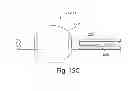 Fig. 17 - MULTI-STAGE PROCEDURES WITH A MODIFIABLE FIBER AND A GUIDE TUBE CONTAINING AN INSTRUMENT