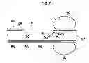 Fig. 07 - Insertion assisting tool for endoscope