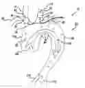 Fig. 01 - Carotid artery occluding apparatus with first and second occluding balloons