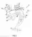 Fig. 03 - Carotid artery occluding apparatus with first and second occluding balloons