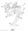 Fig. 04 - Carotid artery occluding apparatus with first and second occluding balloons