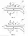 Fig. 05 - Carotid artery occluding apparatus with first and second occluding balloons