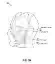 Fig. 04 - Methods for noninvasive skin tightening
