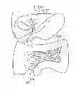 Fig. 01 - Bile duct tube and method of placing thereof
