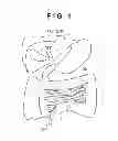 Fig. 02 - Bile duct tube and method of placing thereof