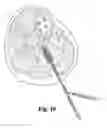 Fig. 13 - Multi-lumen biologic-delivering device
