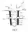 Fig. 03 - Bilateral dynamic external distractor for the treatment of complex fracture luxations of the proximal interphalangeal joint of the hand