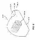 Fig. 06 - Bilateral dynamic external distractor for the treatment of complex fracture luxations of the proximal interphalangeal joint of the hand