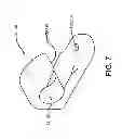 Fig. 07 - Bilateral dynamic external distractor for the treatment of complex fracture luxations of the proximal interphalangeal joint of the hand