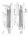 Fig. 06 - Methods and apparatus for luminal stenting