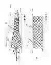 Fig. 07 - Methods and apparatus for luminal stenting