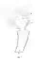 Fig. 02 - Interlocking reverese hip and revision prosthesis and method