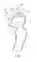Fig. 06 - Interlocking reverese hip and revision prosthesis and method