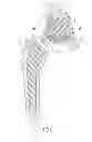Fig. 08 - Interlocking reverese hip and revision prosthesis and method