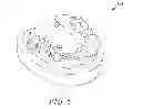 Fig. 07 - SURGICAL GUIDE FABRICATION