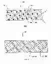 Fig. 02 - Surgical slings