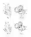 Fig. 02 - Treating dysfunctional cardiac tissue