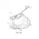 Fig. 35 - Treating dysfunctional cardiac tissue