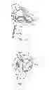 Fig. 49 - Treating dysfunctional cardiac tissue