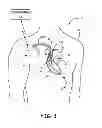 Fig. 02 - Isolating lead body for fault detection